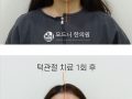 턱관절 추나 체험 1회 전 후