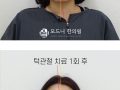 턱관절 치료 1회 전 후