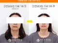 안면비대칭 턱관절 5회 치료 전후사진 후기