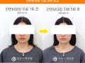 안면비대칭 턱관절 5회 치료 전후사진 후기