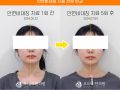 안면비대칭 턱관절 5회 치료 전후사진 후기