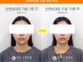 안면비대칭 턱관절 10회 치료 전후사진 후기
